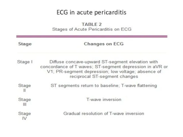 ECG in acute pericarditis