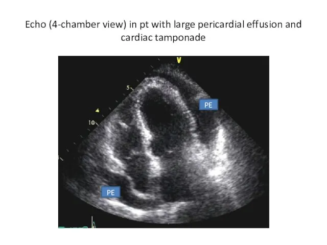 Echo (4-chamber view) in pt with large pericardial effusion and cardiac tamponade PE PE