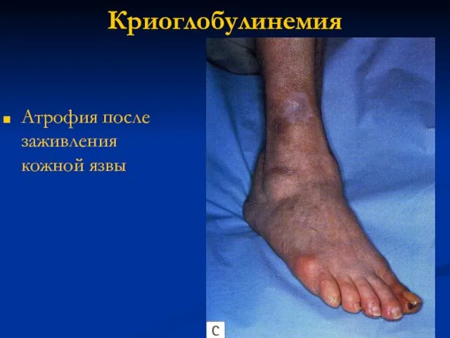 Криоглобулинемия Атрофия после заживления кожной язвы