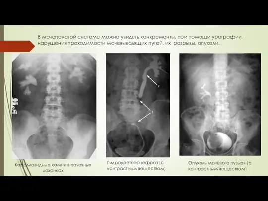 В мочеполовой системе можно увидеть конкременты, при помощи урографии – нарушения проходимости мочевыводящих