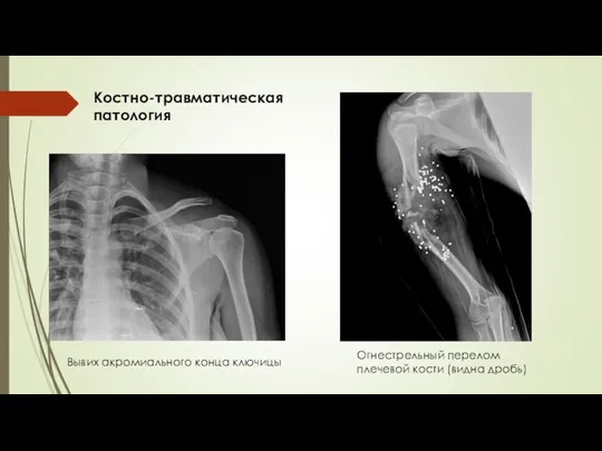 Костно-травматическая патология Огнестрельный перелом плечевой кости (видна дробь) Вывих акромиального конца ключицы