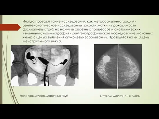 Иногда проводят такие исследования, как метросальпингография - рентгенологическое исследование полости матки и проходимости