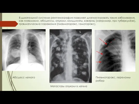 В дыхательной системе рентгенография позволяет диагностировать такие заболевания, как пневмонии, абсцессы, опухоли, кальцинаты,