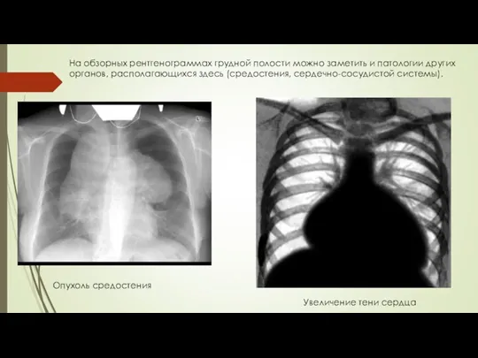 На обзорных рентгенограммах грудной полости можно заметить и патологии других органов, располагающихся здесь