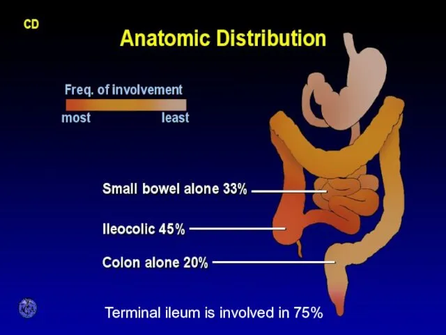 ANATOMIC DISTRIBUTION Terminal ileum is involved in 75%