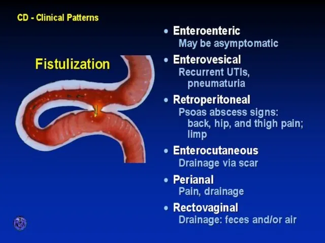 FISTULIZATION