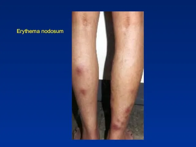 Erythema nodosum