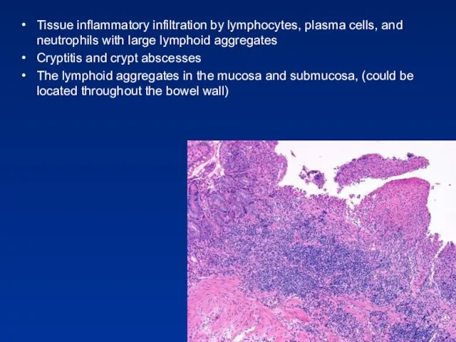 Tissue inflammatory infiltration by lymphocytes, plasma cells, and neutrophils with