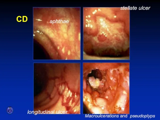 ENDOSCOPIC APPEARANCES CD aphthae stellate ulcer longitudinal ulcer Macroulcerations and pseudoplyps
