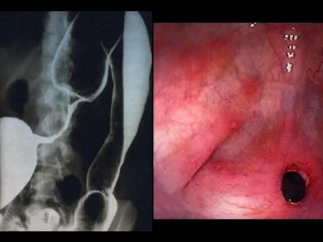 TRANSVERSE COLON STRICTURE