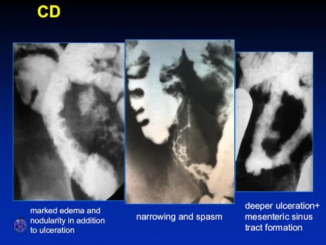 SPECTRUM OF ILEITIS marked edema and nodularity in addition to