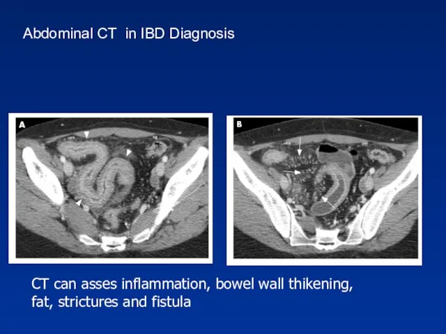 CT can asses inflammation, bowel wall thikening, fat, strictures and fistula Abdominal CT in IBD Diagnosis