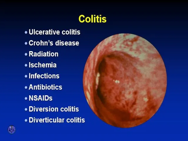 VARIETIES OF COLITIS