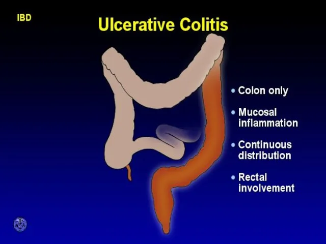 CHARACTERISTIC FEATURES OF ULCERATIVE COLITIS