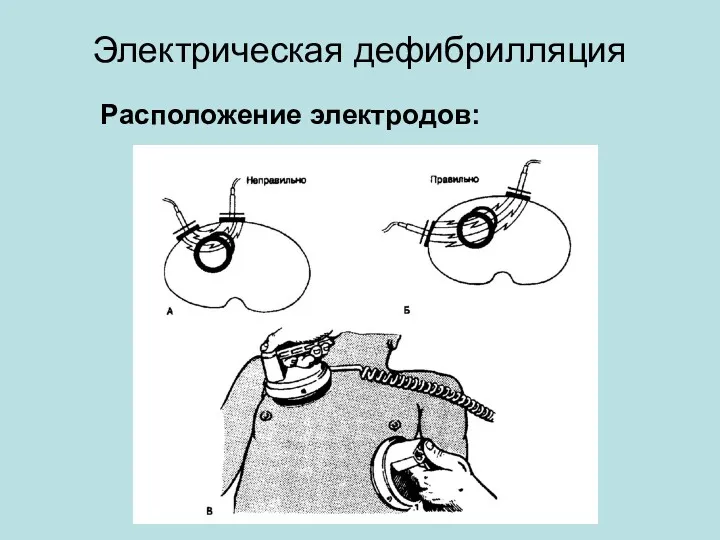 Электрическая дефибрилляция Расположение электродов: