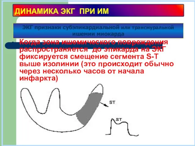 ДИНАМИКА ЭКГ ПРИ ИМ Когда зона ишемического повреждения распространяется до