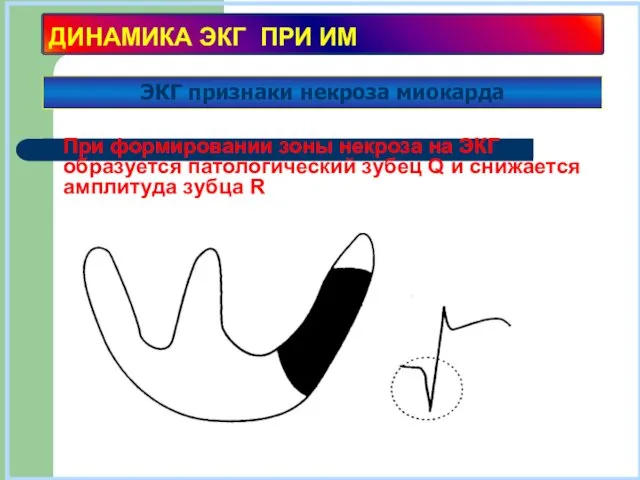 ДИНАМИКА ЭКГ ПРИ ИМ При формировании зоны некроза на ЭКГ