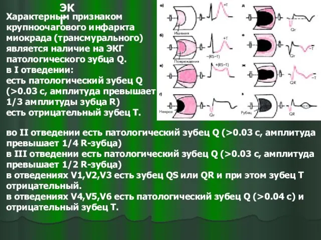 Характерным признаком крупноочагового инфаркта миокрада (трансмурального) является наличие на ЭКГ