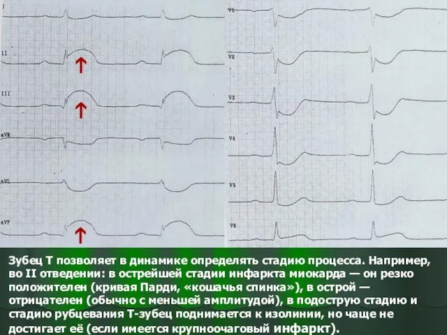 Зубец T позволяет в динамике определять стадию процесса. Например, во