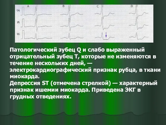 Патологический зубец Q и слабо выраженный отрицательный зубец T, которые