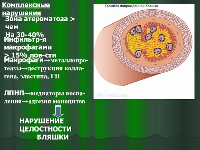 Комплексные нарушения Зона атероматоза > чем На 30-40% Инфильтр-я макрофагами