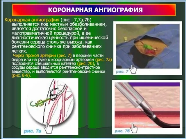 КОРОНАРНАЯ АНГИОГРАФИЯ Коронарная ангиография (рис . 7,7а,7б) выполняется под местным