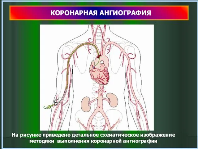 КОРОНАРНАЯ АНГИОГРАФИЯ На рисунке приведено детальное схематическое изображение методики выполнения коронарной ангиографии