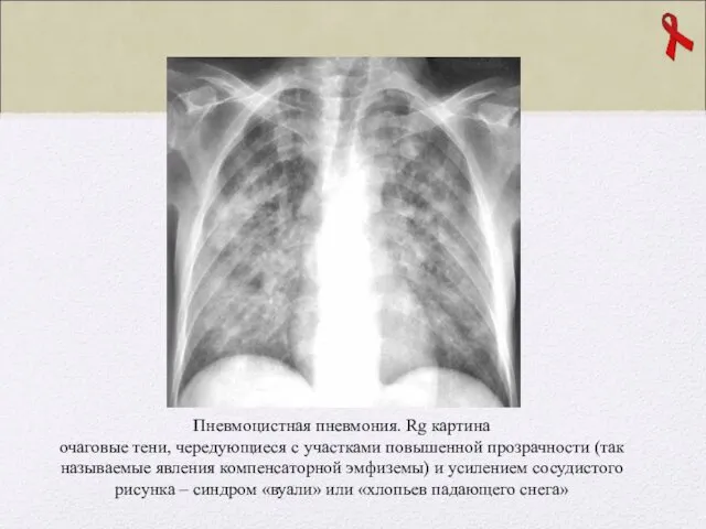 Пневмоцистная пневмония. Rg картина очаговые тени, чередующиеся с участками повышенной