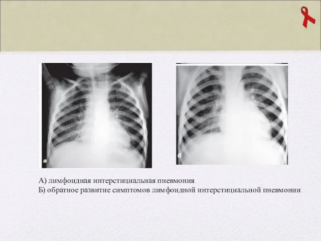 А) лимфоидная интерстициальная пневмония Б) обратное развитие симптомов лимфоидной интерстициальной пневмонии