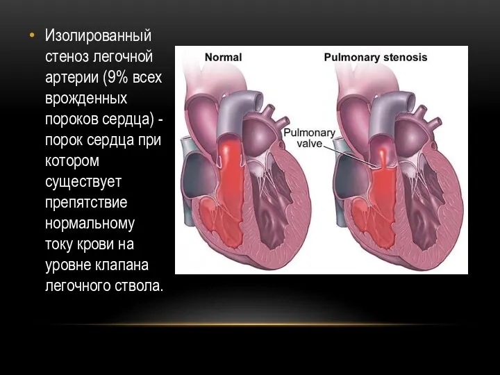 Изолированный стеноз легочной артерии (9% всех врожденных пороков сердца) -