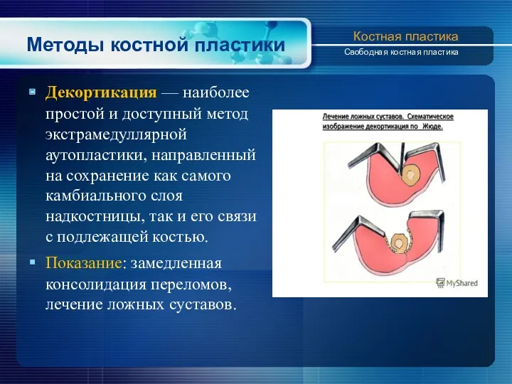 Методы костной пластики Декортикация — наиболее простой и дос­тупный метод