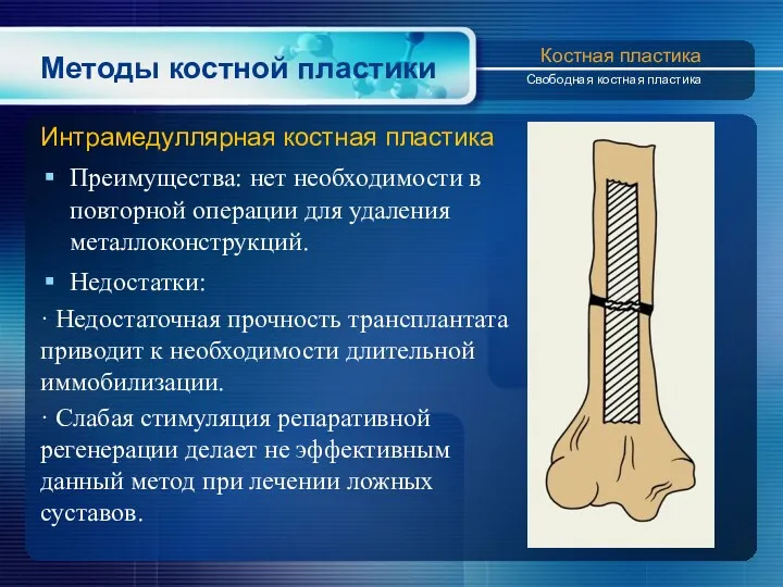 Методы костной пластики Интрамедуллярная костная пластика Преимущества: нет необходимости в