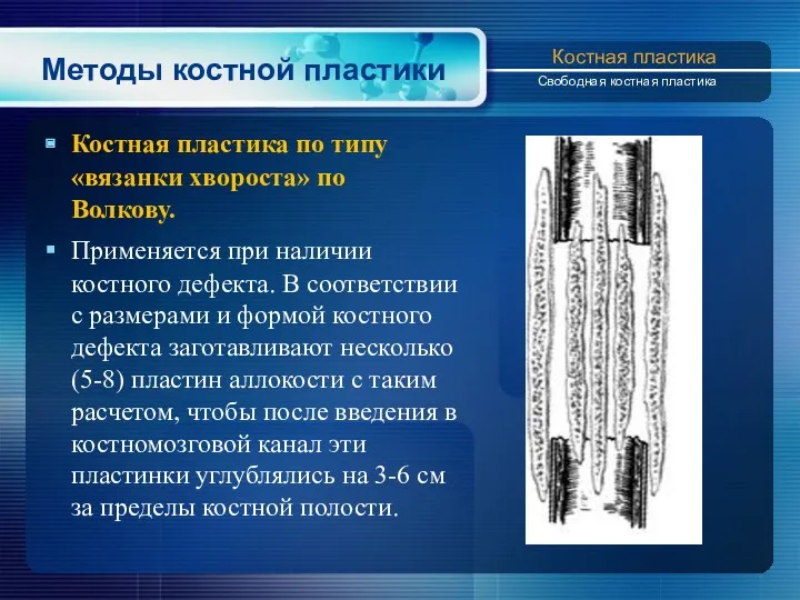 Методы костной пластики Костная пластика по типу «вязанки хвороста» по