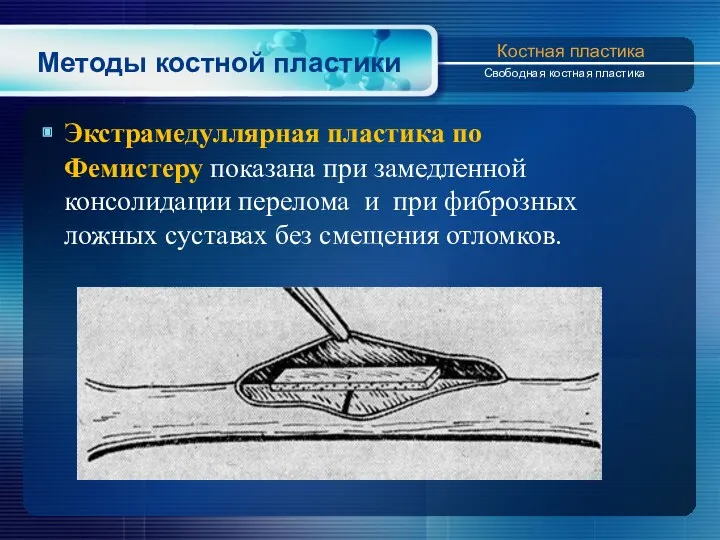 Методы костной пластики Экстрамедуллярная пластика по Фемистеру показана при замедленной консолидации перелома и