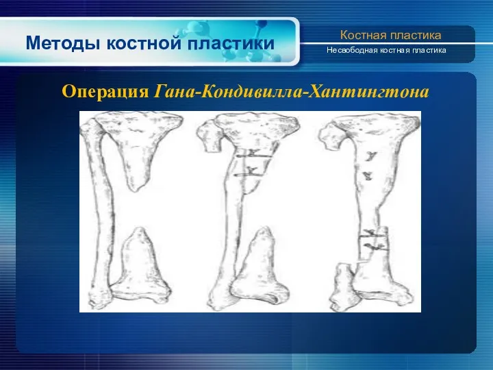 Методы костной пластики Костная пластика Несвободная костная пластика Операция Гана-Кондивилла-Хантингтона