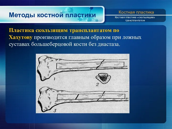 Методы костной пластики Пластика скользящим трансплантатом по Xахутову производится главным образом при ложных