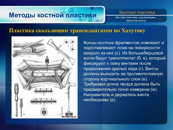 Методы костной пластики Пластика скользящим трансплантатом по Xахутову Костная пластика