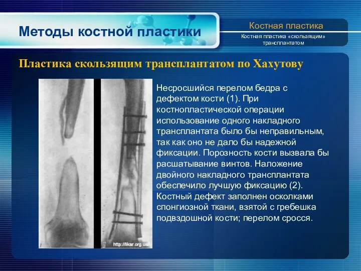 Методы костной пластики Пластика скользящим трансплантатом по Xахутову Костная пластика Костная пластика «скользящим»