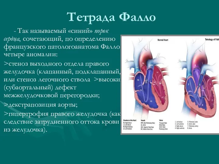 Тетрада Фалло - Так называемый «синий» порок сердца, сочетающий, по определению французского патологоанатома