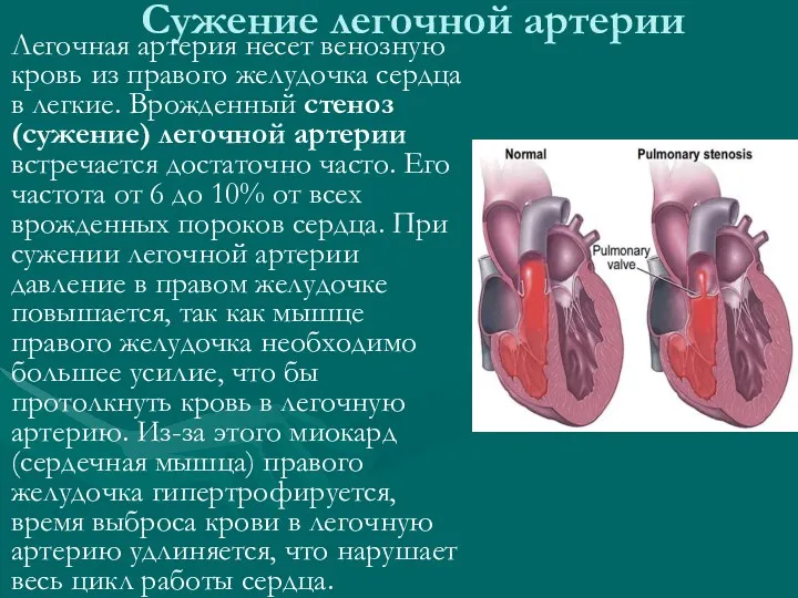Сужение легочной артерии Легочная артерия несет венозную кровь из правого желудочка сердца в