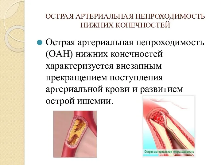 ОСТРАЯ АРТЕРИАЛЬНАЯ НЕПРОХОДИМОСТЬ НИЖНИХ КОНЕЧНОСТЕЙ Острая артериальная непроходимость (ОАН) нижних