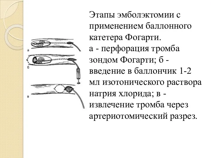 Этапы эмболэктомии с применением баллонного катетера Фогарти. а - перфорация