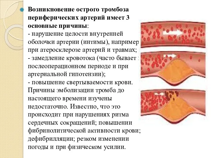 Возникновение острого тромбоза периферических артерий имеет 3 основные причины: -