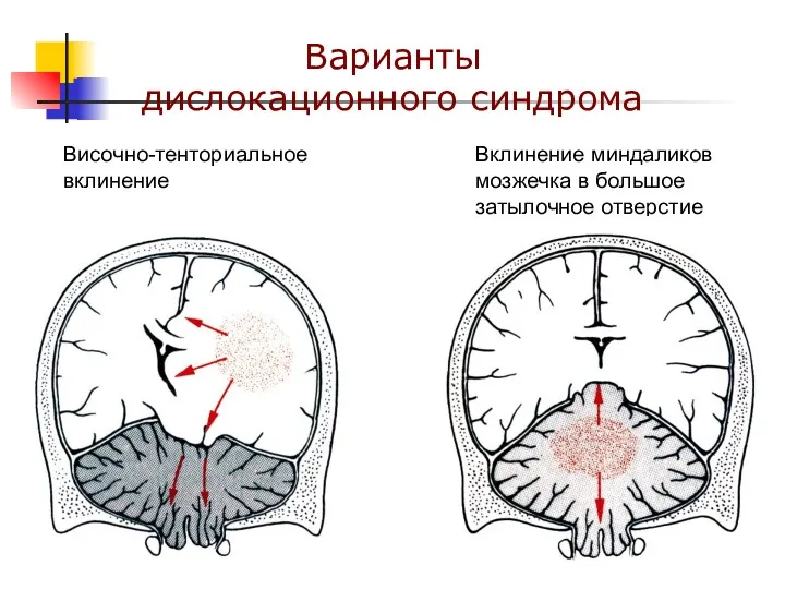 Варианты дислокационного синдрома Височно-тенториальное вклинение Вклинение миндаликов мозжечка в большое затылочное отверстие