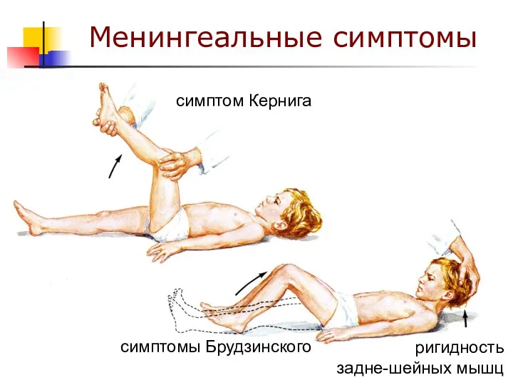 Менингеальные симптомы симптом Кернига ригидность задне-шейных мышц симптомы Брудзинского