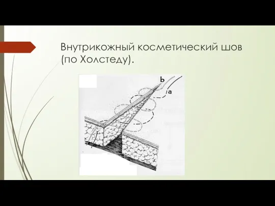 Внутрикожный косметический шов(по Холстеду).