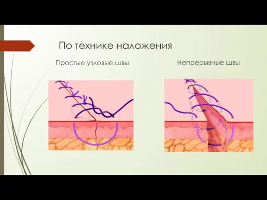 По технике наложения Простые узловые швы Непрерывные швы