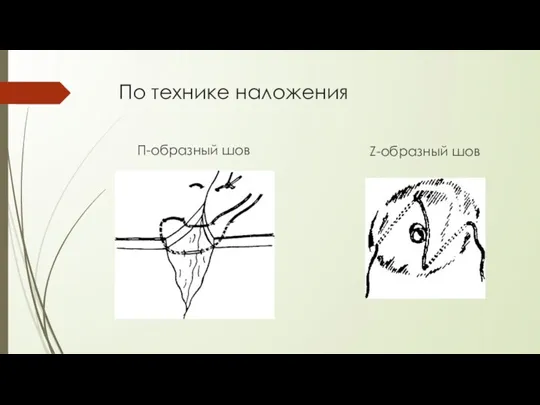 По технике наложения П-образный шов Z-образный шов