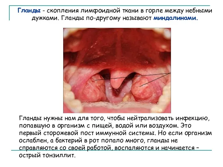 Гланды - скопления лимфоидной ткани в горле между небными дужками.