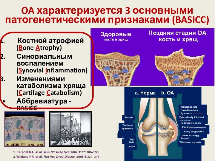 OA характеризуется 3 основными патогенетическими признаками (BASICC) Костной атрофией (Bone